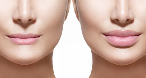 Before and after lip filler injections. Lips closeup over white